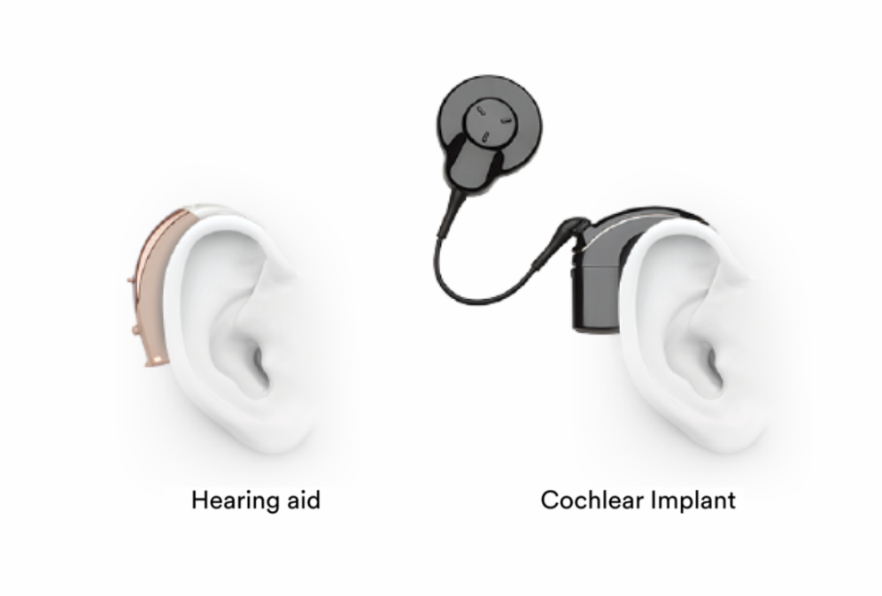 Hearing Aid vs. Cochlear Implant