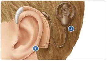Cochlear Implant Internal Component