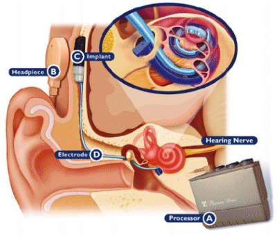 Cochlear Implant External Component