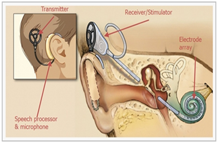 Auditory Brainstem Implant (ABI)  