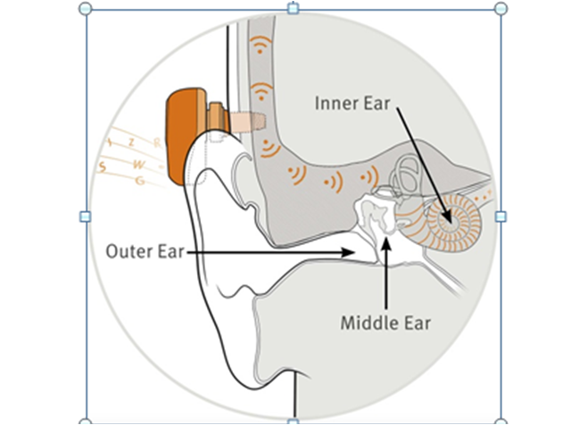 Middle-Ear Implants 